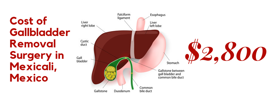 Affordable Cost of Gallbladder Removal Surgery in Mexicali, Mexico